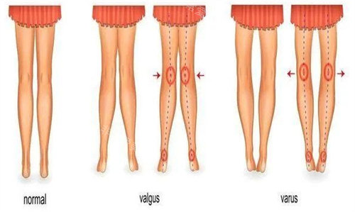 腿型矯正示意圖