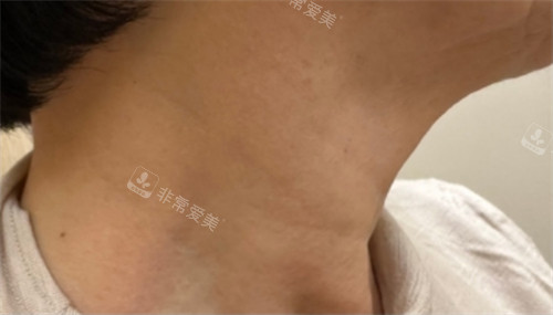 韓國獎杯皮膚科頸部提升術(shù)術(shù)后圖
