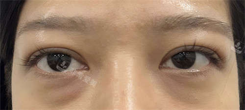 韓國21整形外科眼綜合手術(shù)前 韓國21整形外科眼綜合手術(shù)前
