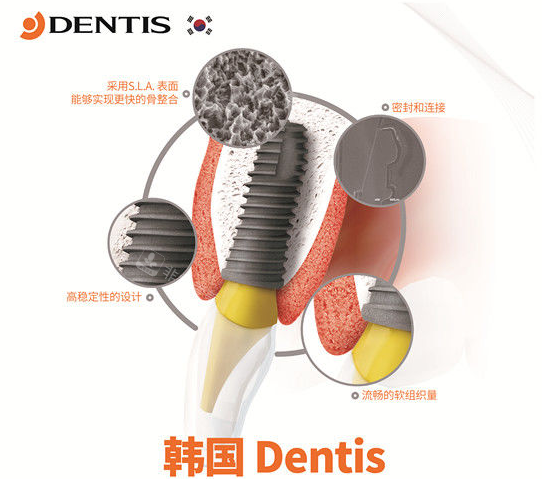 登腾种植牙照片