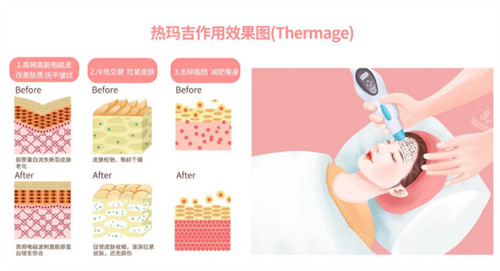 熱瑪吉的作用圖解 熱瑪吉的作用圖解