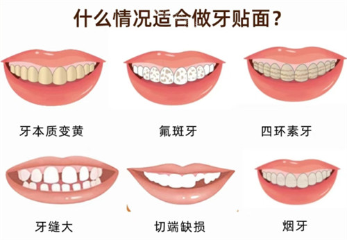 適合做牙貼面的情況