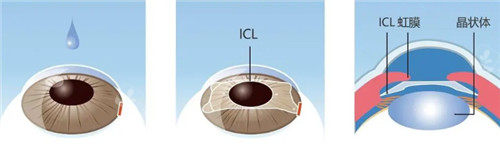 晶体植入手术过程细节图
