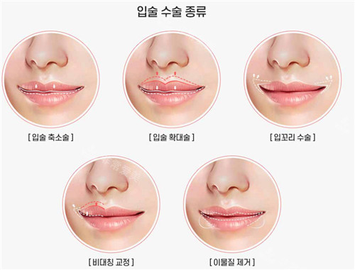 唇腭裂修復(fù)過(guò)程圖 唇腭裂修復(fù)過(guò)程圖