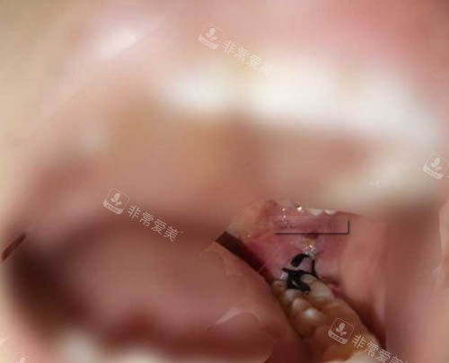 拔牙伤口缝合