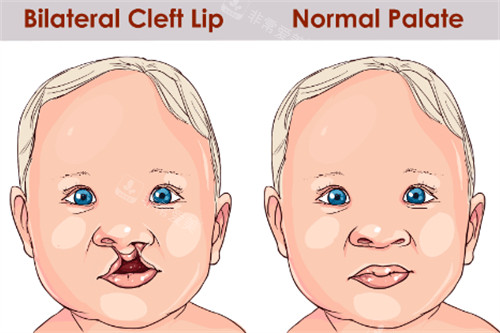 唇腭裂和正常嘴唇的區(qū)別圖解