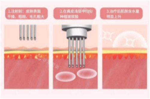 注射水光的過(guò)程圖解 注射水光的過(guò)程圖解