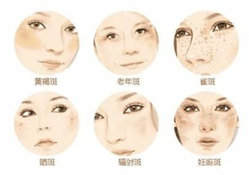 不同斑點(diǎn)的樣子圖解 不同斑點(diǎn)的樣子圖解