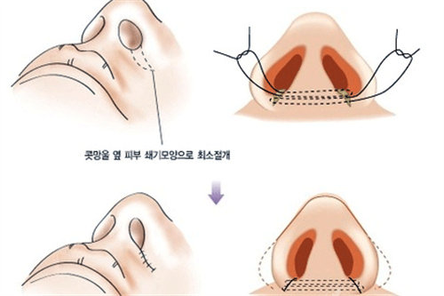 隆鼻手術(shù)不同切口位置圖解