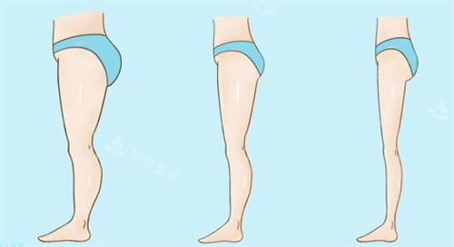大腿吸脂瘦身前后 大腿吸脂瘦身前后