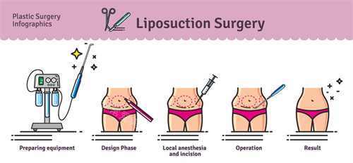 吸脂手術(shù)流程圖