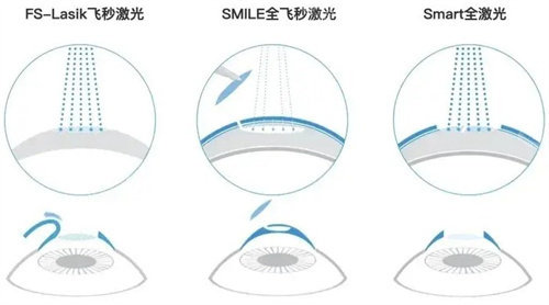 激光的種類(lèi)區(qū)別