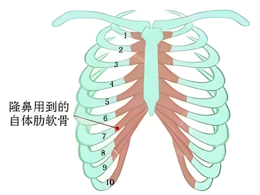 隆鼻肋骨鼻所用肋骨