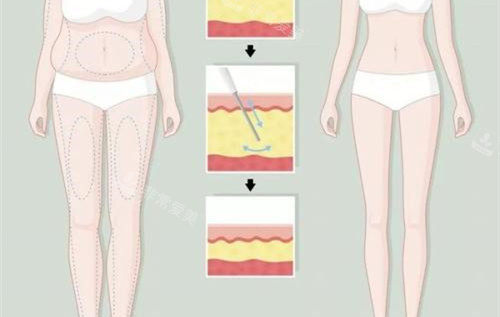 大腿環(huán)吸前后對比卡通示意圖