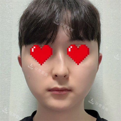 21整形外科鼻子整形术前正面图