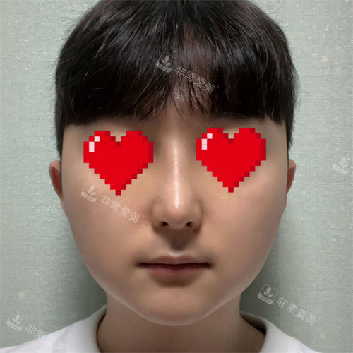 21整形外科鼻子整形术后正面图