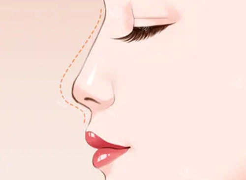 我在韩国做3d硅胶假体+人工真皮+自体肋软骨隆鼻价格是1500w韩币,术后很满意!