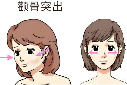 去韩国做了颧骨颧弓和下颌角磨骨手术,价格一共是 2550万韩币,术后秒变小V脸!