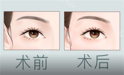 開外眼角術前術后對比