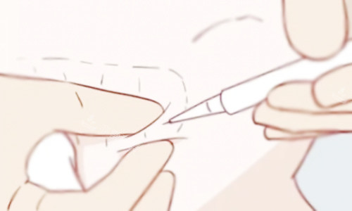 溶脂针