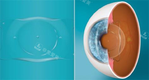 人工晶体植入眼睛的层次