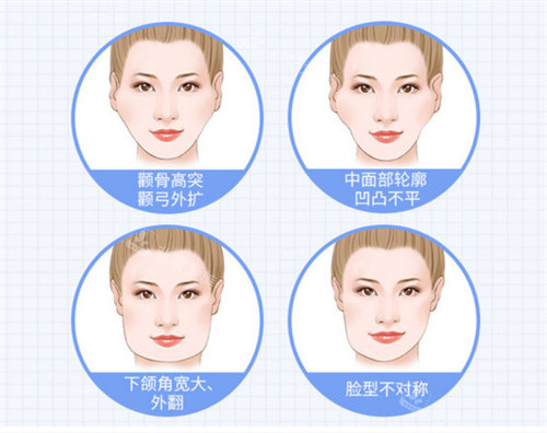 頜面整形適應(yīng)癥 頜面整形適應(yīng)癥