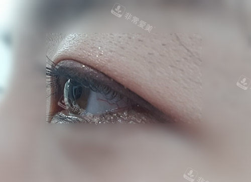 眼皮下垂 眼皮下垂