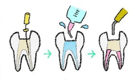 根管治療過程漫畫圖