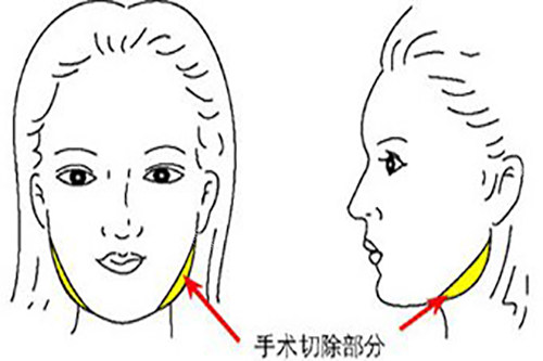 下頜寬大削骨示意圖1