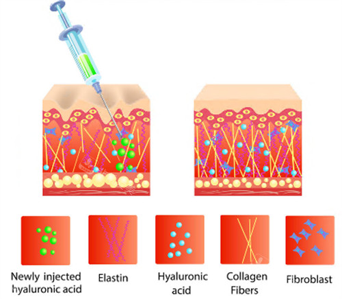 玻尿酸注射原理