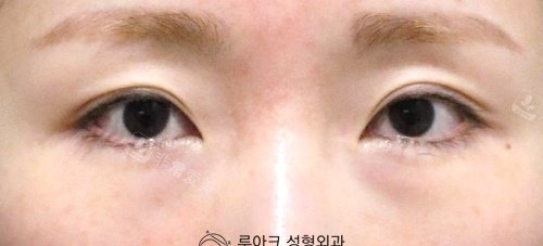 韓國luarc整形眼底脂肪再配置前 韓國luarc整形眼底脂肪再配置前