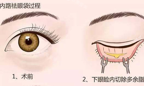 北京做眼袋正规医院哪家好?紫洁整形/丽星翼美/丰联丽格/客来美舍整形祛眼袋和眼袋修复手术有名!