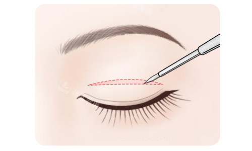 全切雙眼皮切口展示