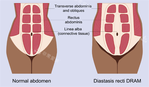 腹壁成形改善肌肉