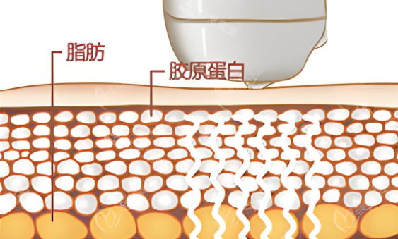 激光溶脂圖 激光溶脂圖