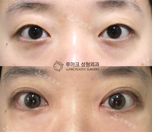 韩国luarc整形非切开式提肌矫正手术前后对比 韩国luarc整形非切开式提肌矫正手术前后对比