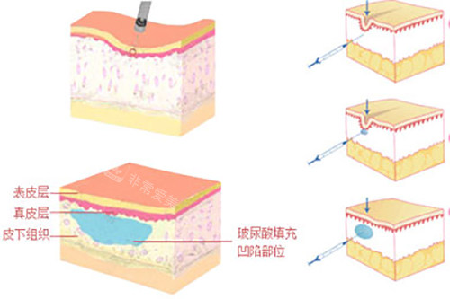 玻尿酸填充皮下组织示意图