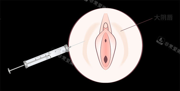 私密陰唇注射照片