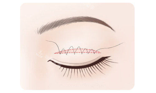 全切雙眼皮縫合