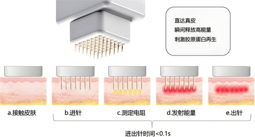 黄金微针作用原理