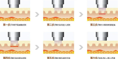 黃金微針過程圖