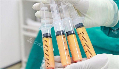 自体脂肪的妙用：我的韩国自体脂肪移植手术经历告诉你答案!