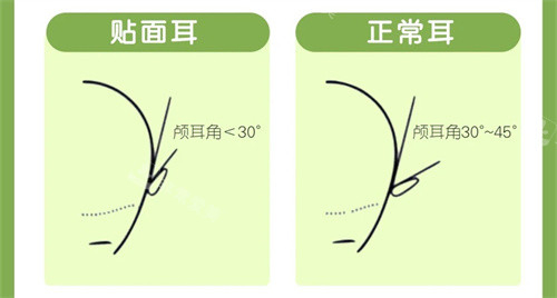 貼面耳與正常耳顱耳角對(duì)比圖