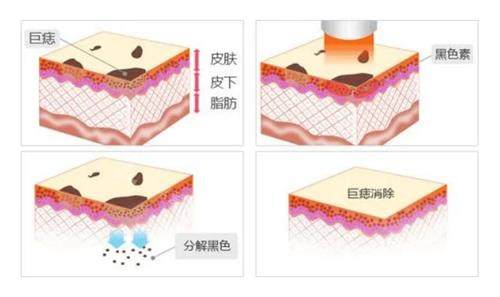 激光去痣过程