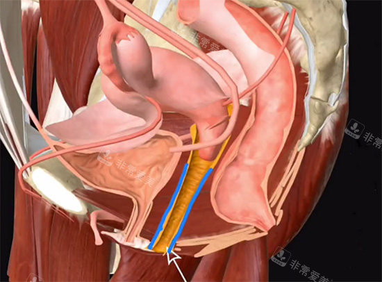 陰道緊縮針動(dòng)畫(huà)原理
