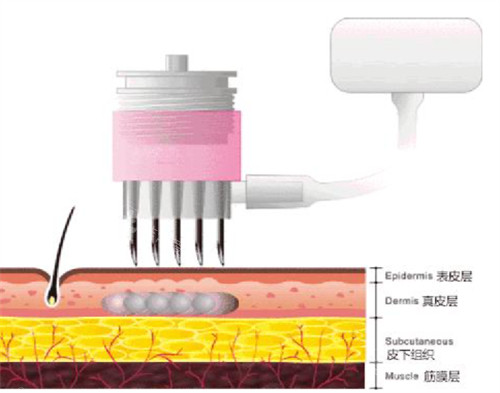 微針可以達(dá)到的肌膚層次圖解