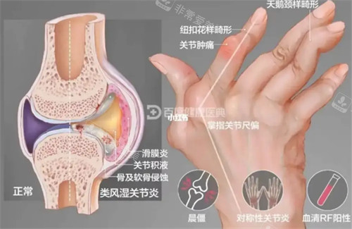 關(guān)節(jié)炎 關(guān)節(jié)炎