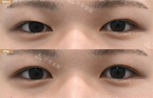 韩国21整形外科医院眼整形对比