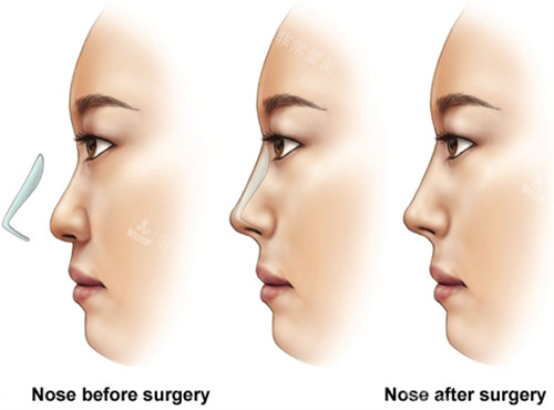 假體隆鼻手術(shù)前后對比
