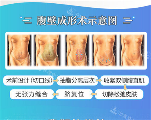 腹壁成形術(shù)示意圖 腹壁成形術(shù)示意圖